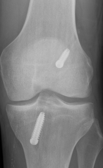 ACL Hamstring 2 x RCI Screws AP